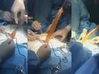 Lekári z pacienta vytiahli takmer metrový umelý úd!