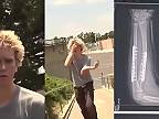 Blonďavý skejťák si zlomil ruku, dostal dva implantáty a 14 skrutiek (DRSNÉ)