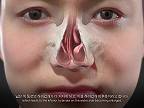 Videoanimácia funkčnej rhinoplasplasty Video Animation - Newjean plastic surgery