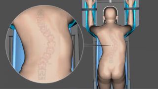 Operácia skoliotickej chrbtice - detailná animácia