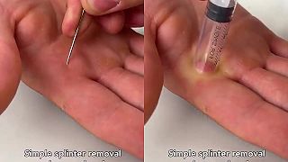 video Zaujímavý spôsob ako vybrať z ruky triesku (pomocou injekčnej striekačky)