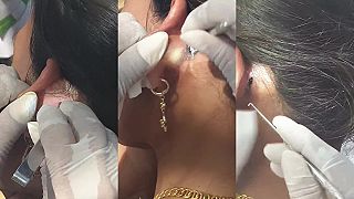 video Doktor na vzdialenom vidieku v Kambodži ošetril žene obrovskú dieru za uchom