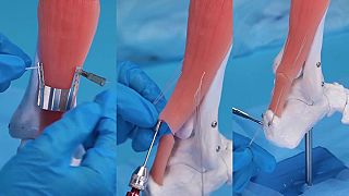 video Presný postup operácie, pomocou ktorej sa zošíva roztrhnutá Achillova šľacha