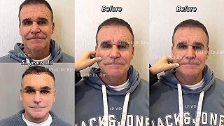 video 51-ročný muž potreboval našponovať ksicht, aby vyzeral mladšie