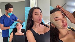 video Ďalšia spokojná klientka plastickej chirurgie