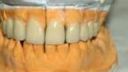 Medzera - diastema