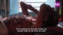 Ochorenie neurofibromatózou