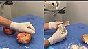 Chirurg ukazuje minimálne 25 rokov staré prsné soľné implantáty