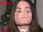 Connie Culp - Žena s transplantovanou tvárou