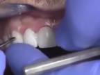 Ako sa robia ľudom biele zuby