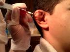 Ošetrenie čerstvého "karfiólu" na uchu mladého zápasníka