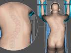 Operácia skoliotickej chrbtice - detailná animácia