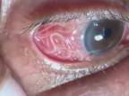 Pacient s hlísticami Loa loa v oku (NECHUTNÉ)