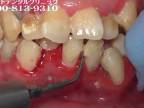 Čistenie chrupu zaneseného veľkým množstvom zubného kameňa