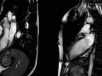 Bijúce srdce cez MRI
