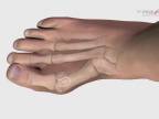 Operácia vybočeného palca (animácia)