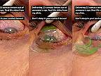 Američanke odstránili z oka 23 kontaktných šošoviek, ktoré jej skĺzli za oko