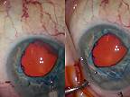 Roztiahnutie zrenice počas operácie oka pomocou expanzného prstenca