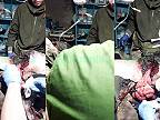 Roztrhaný ukrajinec na operačnom sále 18+