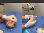 Chirurg ukazuje minimálne 25 rokov staré prsné soľné implantáty