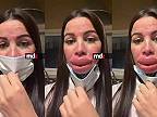 Žena si dala napichať do pier kyselinu hyalurónovú, objavili sa nežiadúce účinky