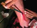 Domáca chirurgia so zúbkatým nožíkom