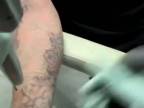 Odstránenie tetovania laserom