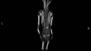 CTScan Atacama alien.