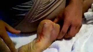 ABSCES V PATE
