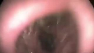 Neuveríte, čo našiel doktor v nose pacienta!
