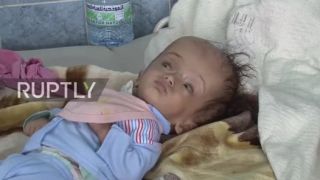 Jemen: novorodenecké deformácie sa množia po dvoch rokoch voj