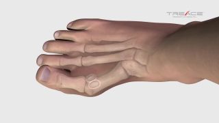 Operácia vybočeného palca (animácia)