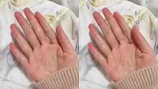 Ktorý prostredník ti mám ukázať? (Polydaktýlia)