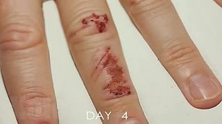 Časozberné video z hojenia poraneného prstu