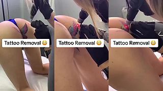 Tetovanie okolo análneho otvoru sa jej už nepáčilo, dala si odstrániť laserom