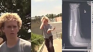 Blonďavý skejťák si zlomil ruku, dostal dva implantáty a 14 skrutiek (DRSNÉ)