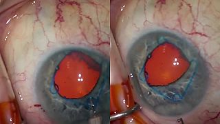Roztiahnutie zrenice počas operácie oka pomocou expanzného prstenca