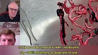 V telách náhle zosnulých ľudí sa začali objavovať obrovské proteínové zrazeniny!