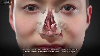Videoanimácia funkčnej rhinoplasplasty Video Animation - Newjean plastic surgery