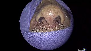 video Mužovi opuchol nos a tvár, doktori mu z dutín vybrali 150 živých lariev (DRSNÉ)