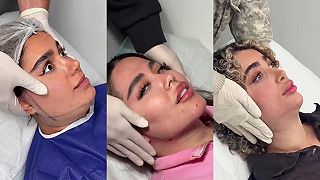 video Keď plastický chirurg odsaje z tváre trochu tuku a prípadne spraví lifting