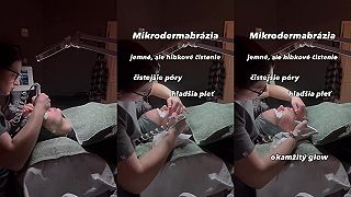 Mikrodermabrázia - Kozmetický salón | Bratislava - Dlhé Diely