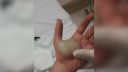 video Obrovský pľuzgier na dlani (popálenina 2. stupňa)