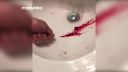 video Čo urobiť s krvou pod nechtom?