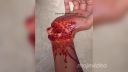 video Otvorená zlomenina zápästia (ŠPECIÁLNY MAKEUP)