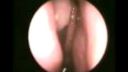 Paraziti v nose