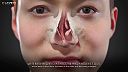 Videoanimácia funkčnej rhinoplasplasty Video Animation - Newjean plastic surgery